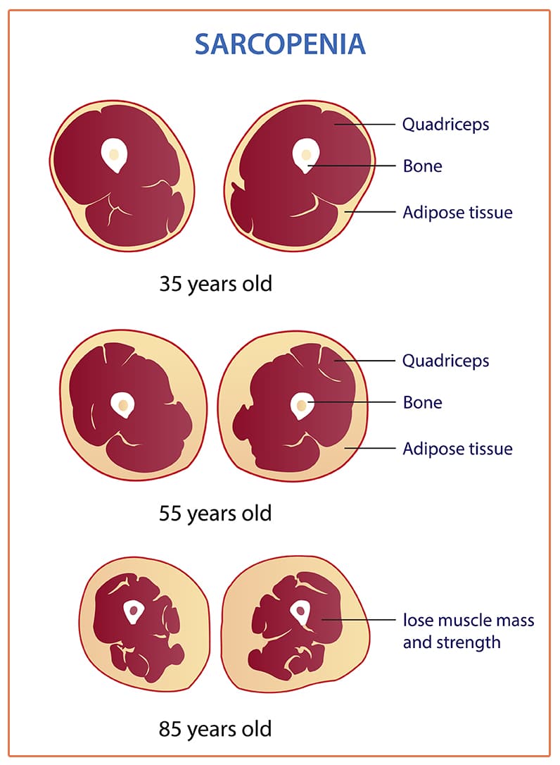 Infographic of sarcopenia vector illustration isolated on white