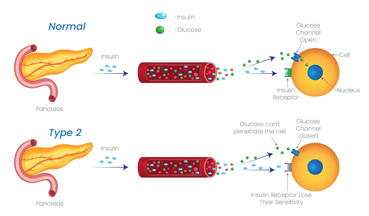 how diabetes works infographic