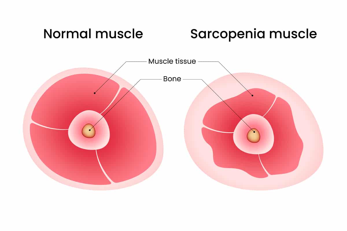 protein and sarcopenia muscle loss